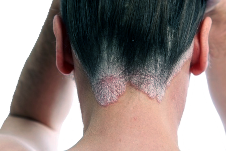 First MHRALicensed Patch Test For Hair Allergies Launched  HJI
