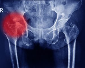 An X-ray highlighting a damaged right hip.