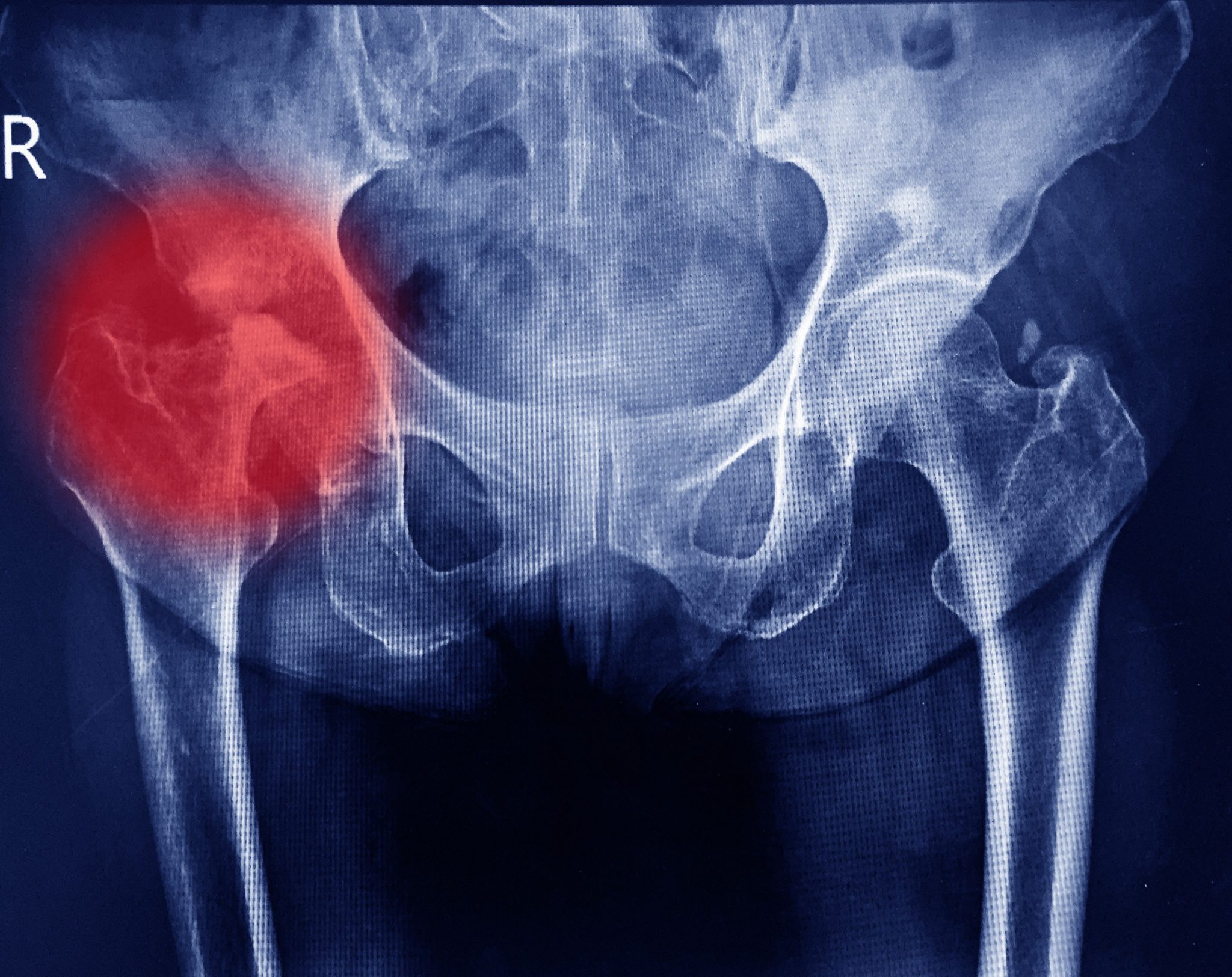 150-000-compensation-for-hip-replacement-injury-claim