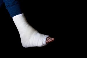 An ankle wrapped in plaster and bandages