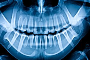 An X-ray image of a set of teeth. 