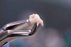 An extracted tooth in metal plyers.