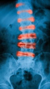 BACK X-RAY SHOWING VERTEBRAE IN RED TO INDICATE SPINAL CORD INJURY