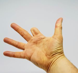 PHOTO OF A HAND WITH INDEX FINGER MISSING