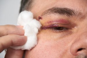 A man with an eye injury