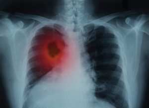 A chest x-ray shows the symptoms of lung cancer. 