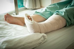 A person lays in bed with a plastered leg.