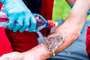 MEDIC TREATING PERSON WITH A SERIOUS BURN INJURY TO THEIR ARM