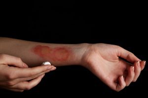 PERSON TREATING THEIR BURN INJURY ON THE FOREARM