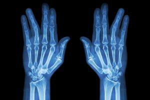 An x-ray shows a finger fracture. 