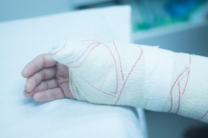 An arm in a white cast resting on a table.