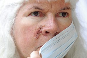 A lady with a mask has a facial scar that is being held together with stitches.